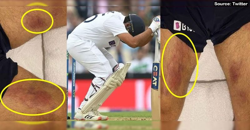 Indian opener Rohit Sharma sustained bruises on his thigh during the fourth test match at Oval.